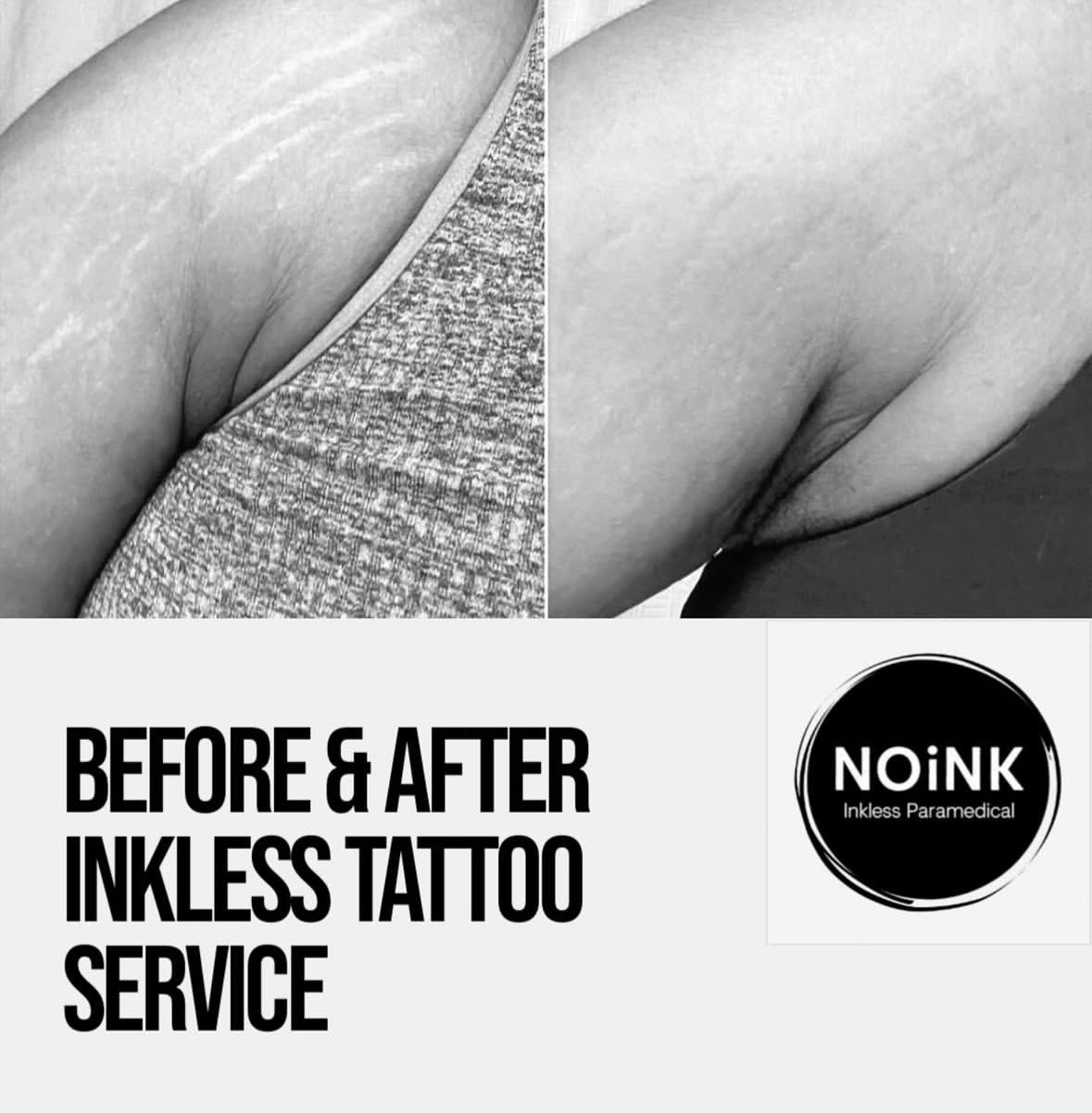Inkless Stretch Mark Treatment - Before & After
