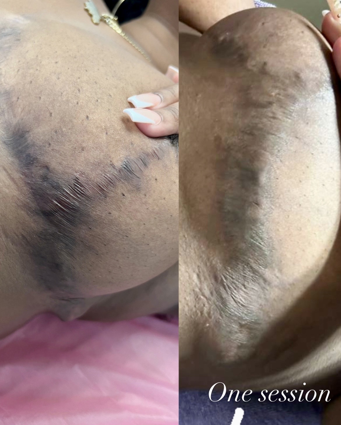 Scar Camouflage - After One Session